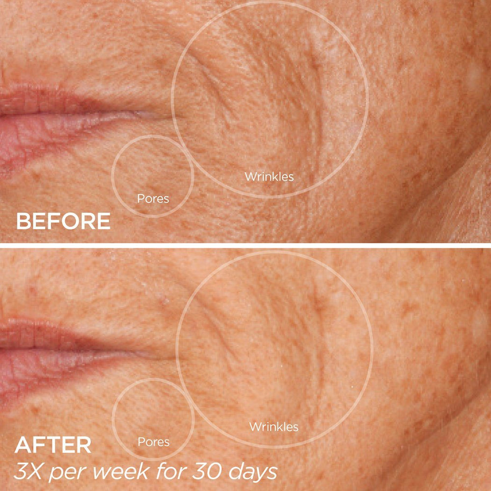 Facial Microneedling Tool