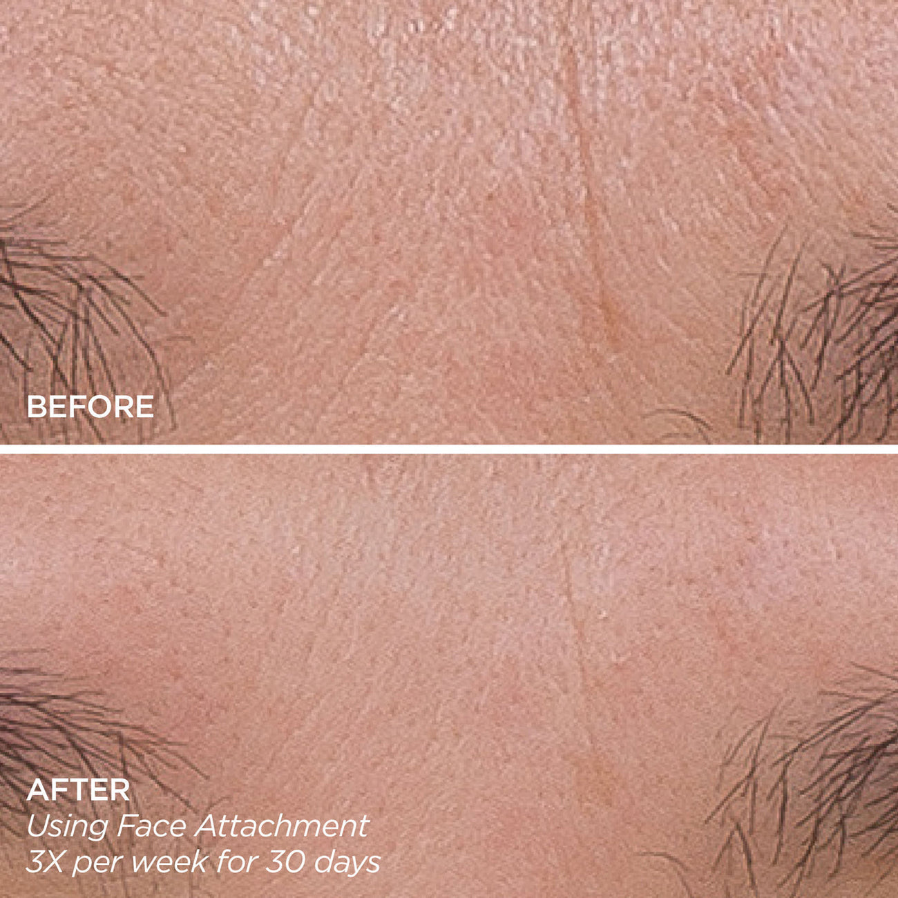 Facial Microneedling Tool