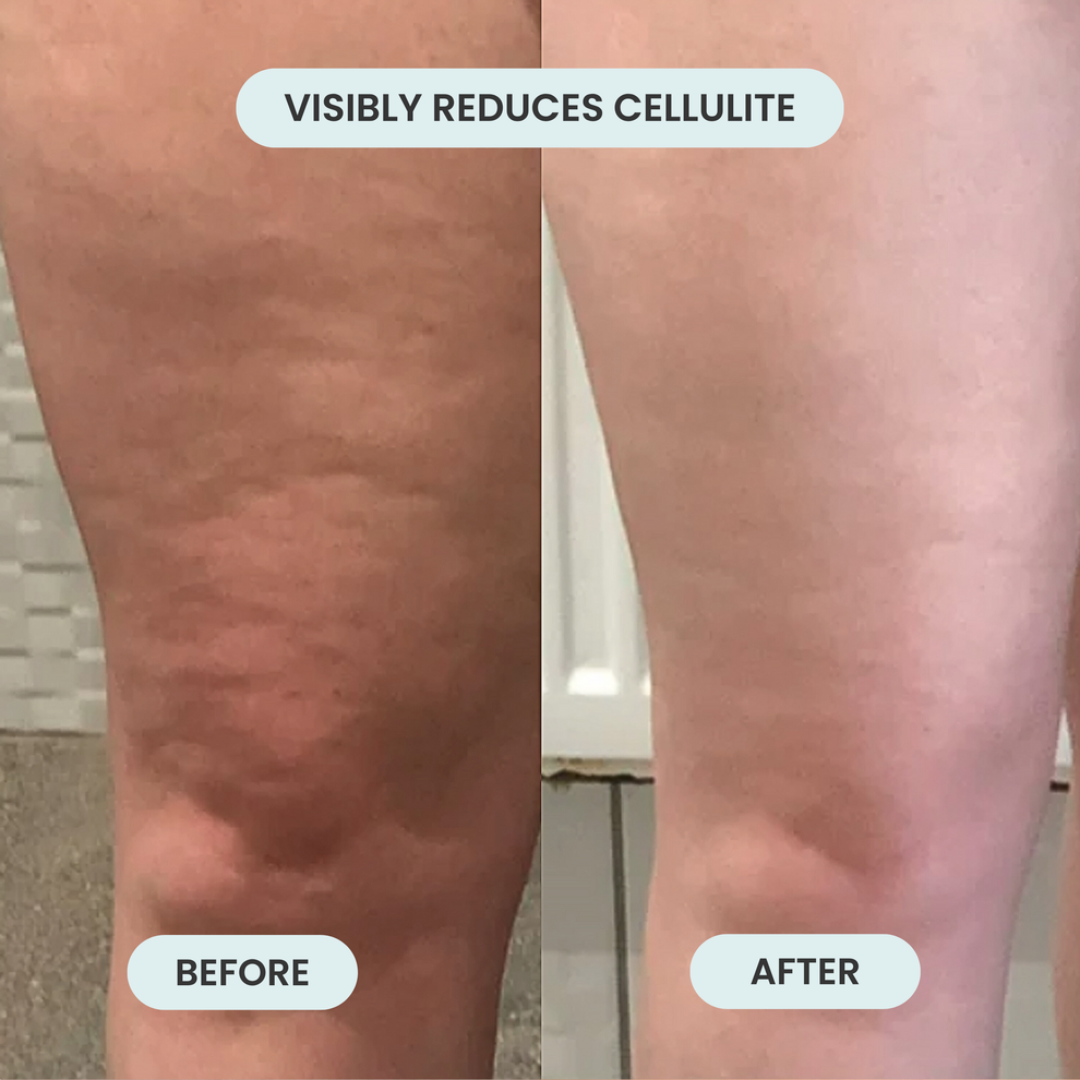 Anti-Cellulite Fascia Massager