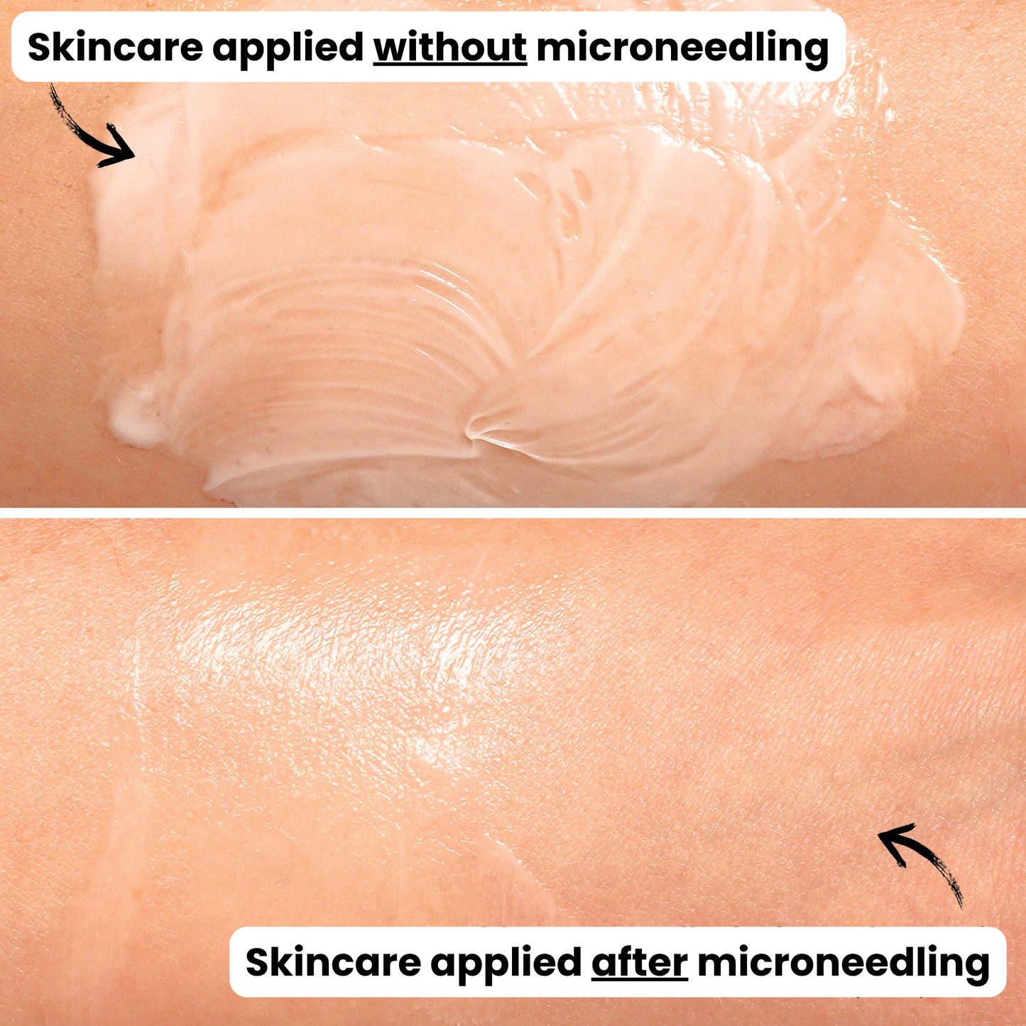 Facial Microneedling Tool